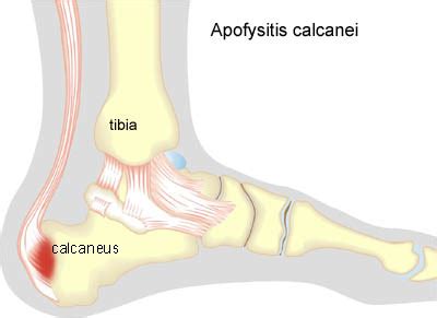 Inflammation of the Achilles tendon attachment - Sportnetdoc