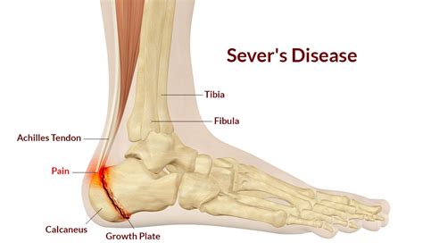 Sever's Disease Symptoms, Causes, Physical therapy Treatment