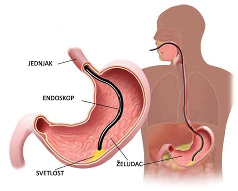 Upper GI Endoscopy