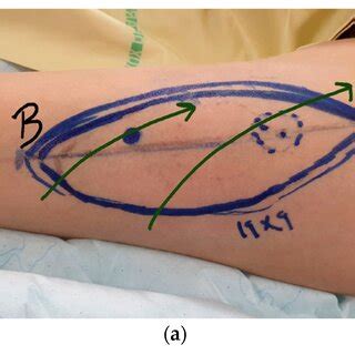 (a) Post-traumatic reconstruction with ALT flap using ICG guided flap... | Download Scientific ...