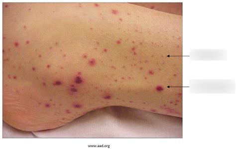 Ecchymosis Vs Petechiae