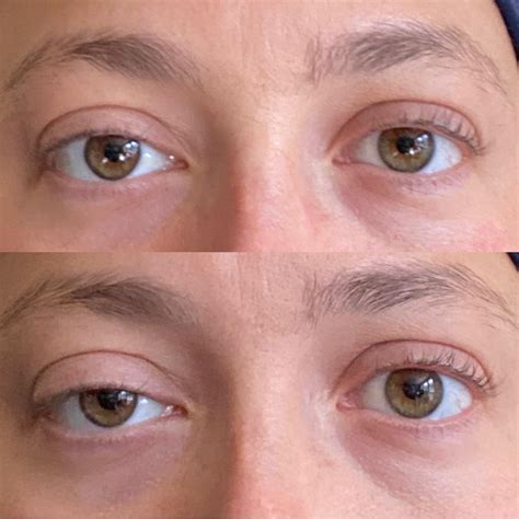 Upneeq for congenital ptosis! Used in my right eye only (left side on the photo) : r/30PlusSkinCare