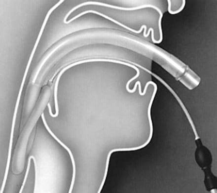 The laryngeal mask airway: potential applications in neonates | ADC Fetal & Neonatal Edition