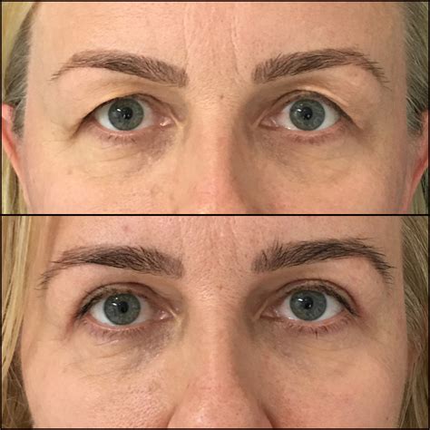 Upper Blepharoplasty Before & After Photos | Flora Levin MD