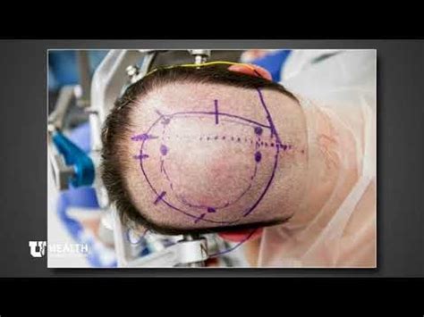 Arnold-Chiari Malformation Decompression Surgery - YouTube | Chiari ...