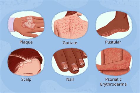 Everything to Know About Psoriasis Types and Symptoms