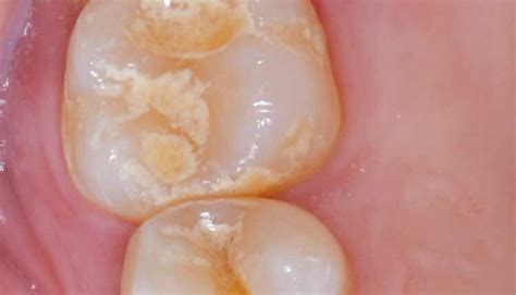 An Unusual Presentation of Peripheral Ossifying Fibroma - Decisions in ...