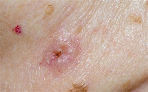 MRSA - Symptoms, Causes, Risk Factors And Complications