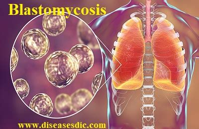 Blastomycosis – Causes, Complications, and Prevention.