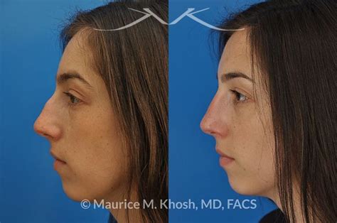 Nose Job Before And After Bump - Rhinoplasty New York New York Nose Job ...