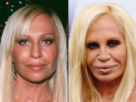 22 Celebrities Before And After Plastic Surgery | Versace, Plastic