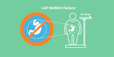 LAP-BAND® Problems and Complications - Complete List - Bariatric Surgery Source