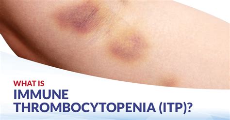 Idiopathic Thrombocytopenic Purpura Rash