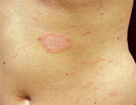 Pityriasis Rosea Pictures, Stages, Causes, Treatment, Causes