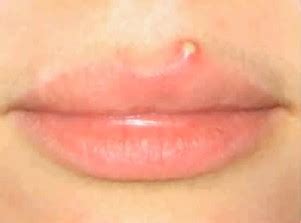 Pimple on Lip Line – Inside the Clinic