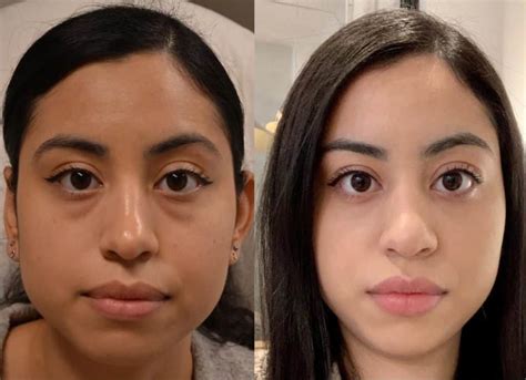 Lower Blepharoplasty Before and After Photos | Fresh Face + Eye