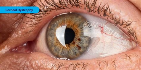 Corneal Dystrophy - Symptoms, Causes and Treatment | FYEyes