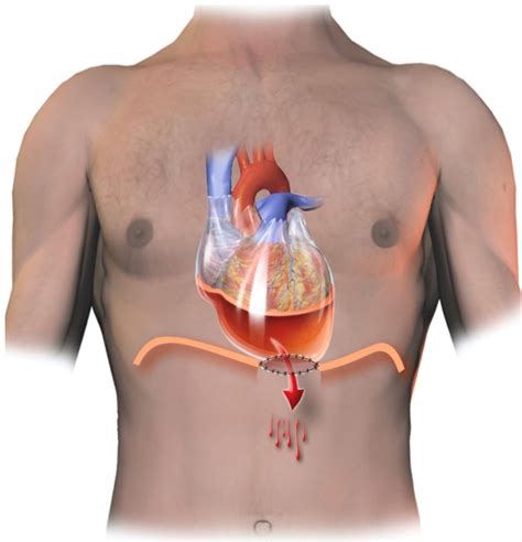 SciELO - Brasil - Pericardial-Peritoneal Window as an Alternative Treatment for Large and ...