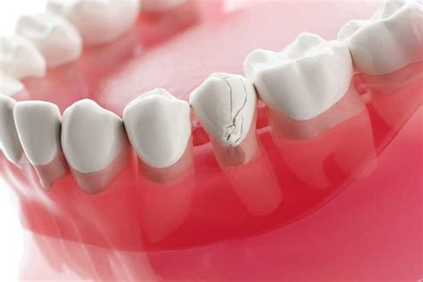 Dental Trauma Treatment Roseville, CA — Matthew R. Comfort, DDS, MAGD, FICD, AACDmip