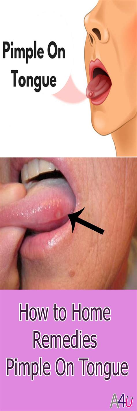 how to Home Remedies Pimple On Tongue | Sore Tongue | Tongue sores ...