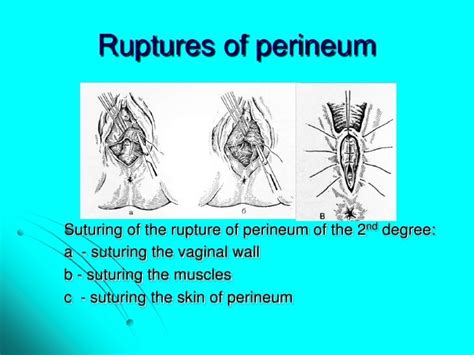 Maternal trauma. obstetric surgeries