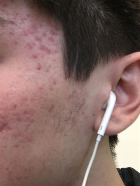 adapalene for acne scars reddit - Pamela Hudson