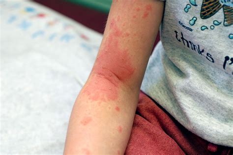 Common Skin Rashes in Children: 16 Types and Causes