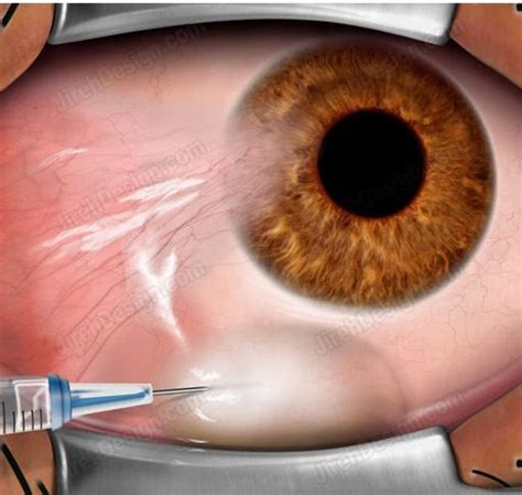 Pterygium removal surgery step - SUCO0030 | Stock eye images