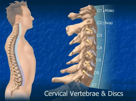 Degenerative Disc in the Neck