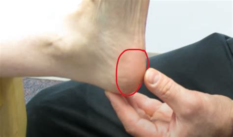 How do you treat a fat pad contusion? - Newman Feet