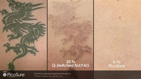 Laser Tattoo Removal You Can Be Sure Of with PicoSure — Norah Clair Aesthetics