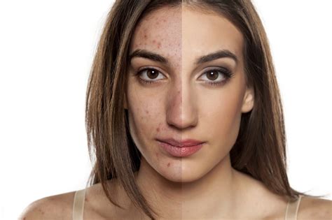Ways to Treat Hyperpigmentation Using Azelaic Acid – Cosmetics and you : Acne Treatment ...