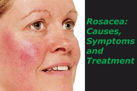 Rosacea Types Causes Symptoms Diagnosis Risk Factors - vrogue.co