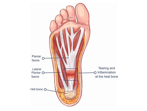 Treating Plantar Fasciitis - With a High Load Strength Training Program