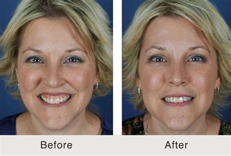 Botox for Gummy Smile Charlotte, NC | Carolina Facial Plastics