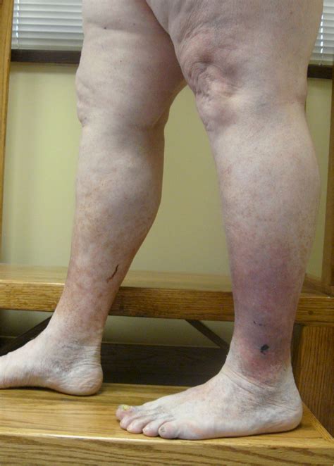 Stasis Dermatitis - Varicose Veins and Skin Problems