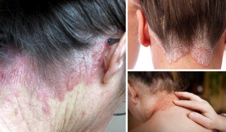 Psoriasis on the neck – Causes, Symptoms & Treatment | Psoriasis expert