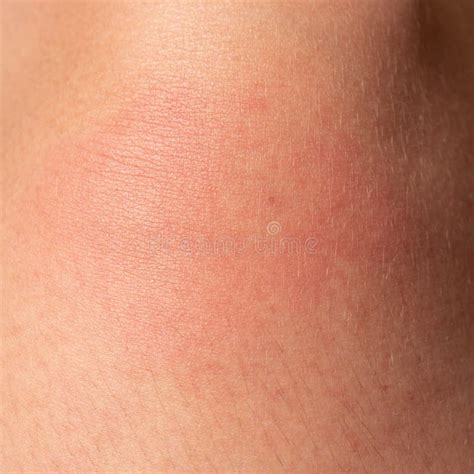 Allergy on the Human Body and Redness from a Wasp Sting. Stock Photo - Image of bite, person ...