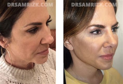 Jennifer Fessler Facelift & Nose Job | Dr. Rizk’s Patient