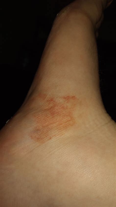 Foot Rash / Covid 19 Images Dermnet Nz - Chilblains and chilblain lupus erythematosus.