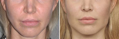 Plastic Surgery Case Study - Female Jaw Angle Implants for a More Defined Jawline - Explore ...