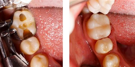 Root canal for a broken tooth – Broken Teeth