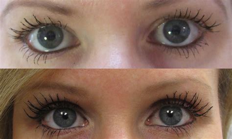 Eyelash Treatment Before and After Photos | Latisse | Woodbridge, Vaughan