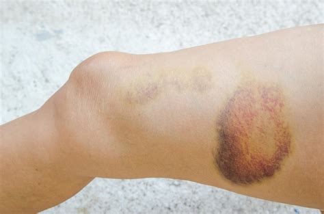 Hematoma Definition