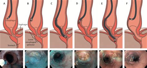 Submucosal surgery: novel interventions in the third space - The Lancet ...