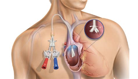 The Pristine™ Long-Term Hemodialysis Catheter: Physicians’ Perspectives - Endovascular Today