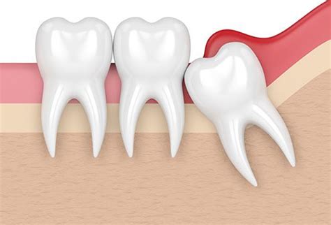 Wisdom Tooth Infection: Symptoms, Treatments, Preventions