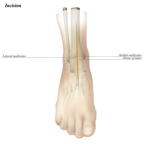 Ankle Anterior Approach - Approaches - Orthobullets