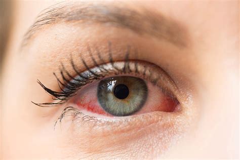 Are Your Red Eyes Allergies or Coronavirus?: Scott Beeve, M.D., FACS: Ophthalmologist