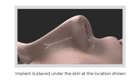 Latera® Nasal Implant | Nasal Airway Obstruction | ENT Doctors